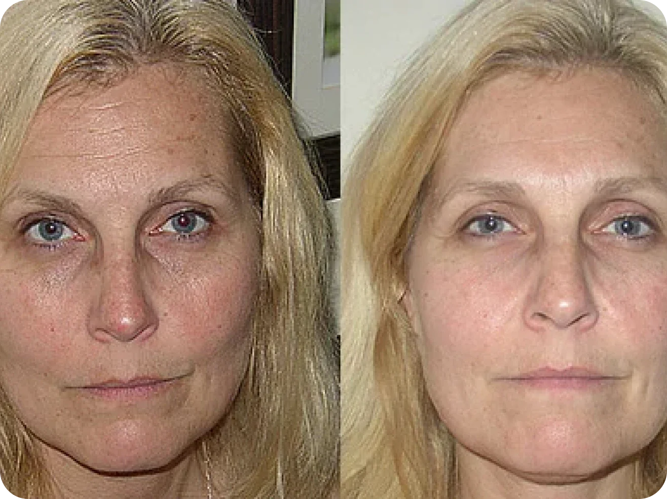 Olavita Botox Serum User